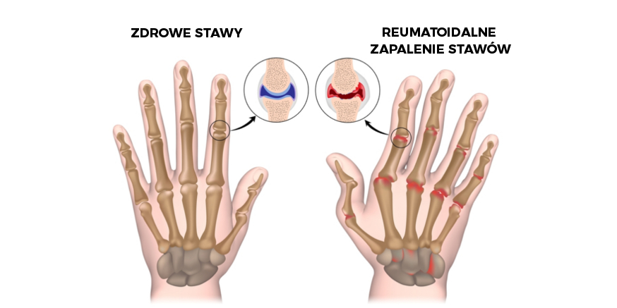 Olej CBD a Reumatoidalne Zapalenie Stawów