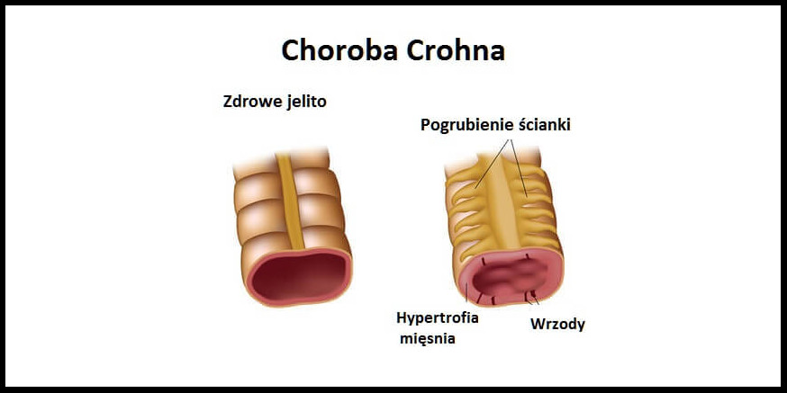 Olejek CBD a choroba Leśniewskiego-Crohna